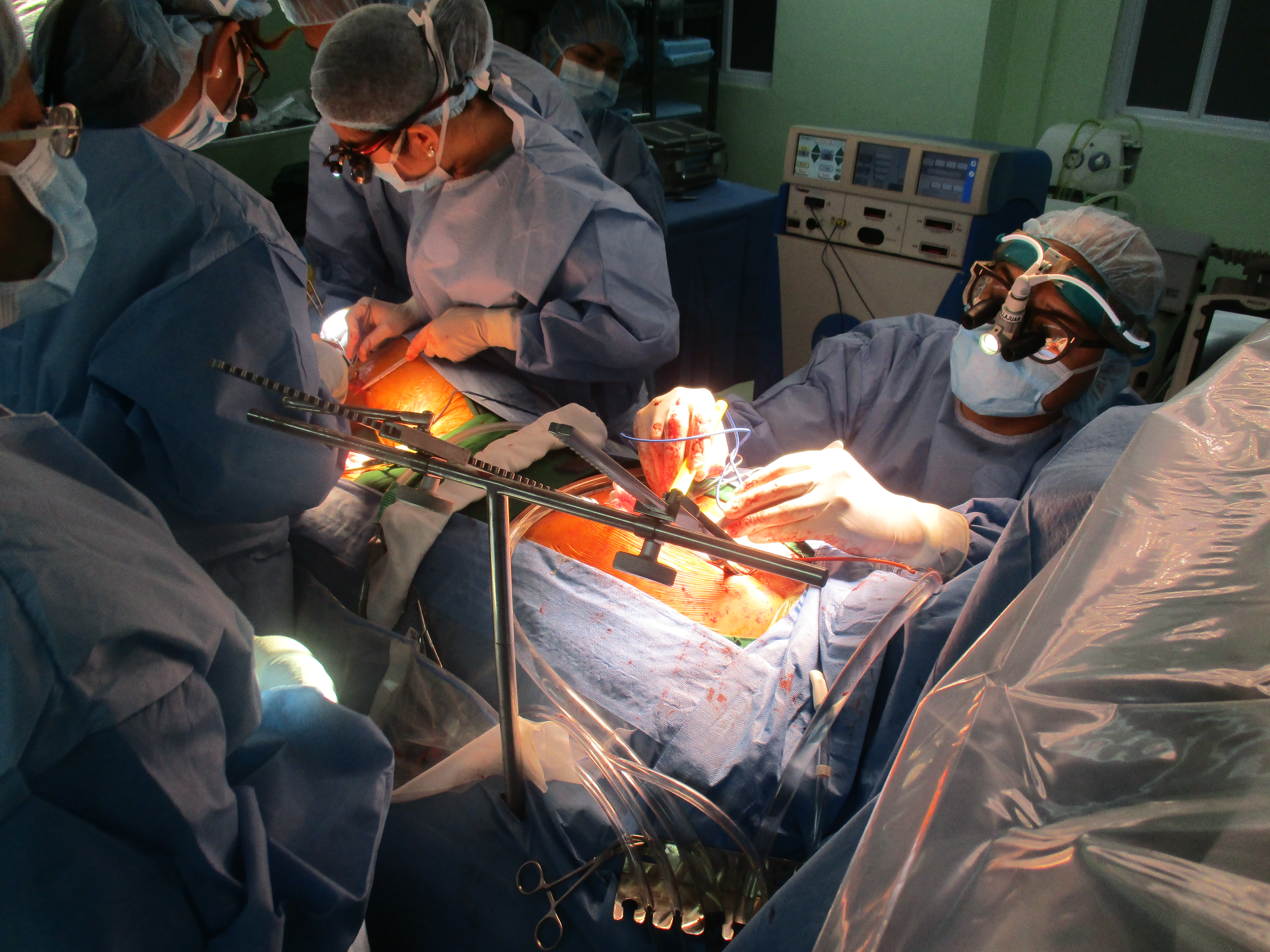 Coronary Artery Bypass Graft Surgery (CABG)